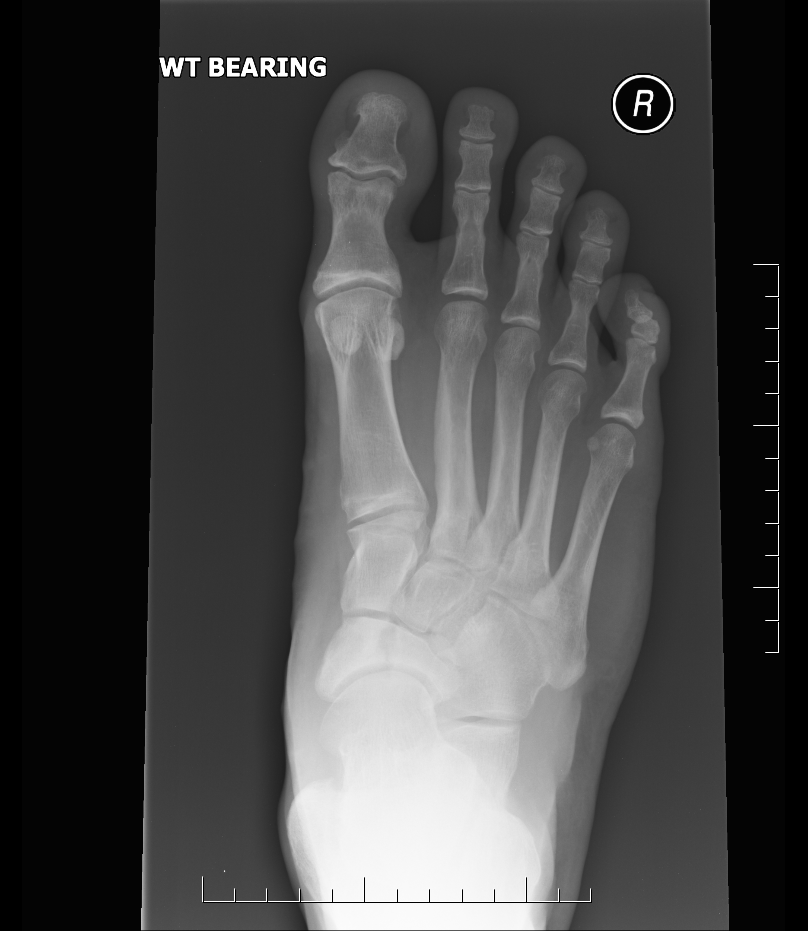 Navicular fractures The Bone School